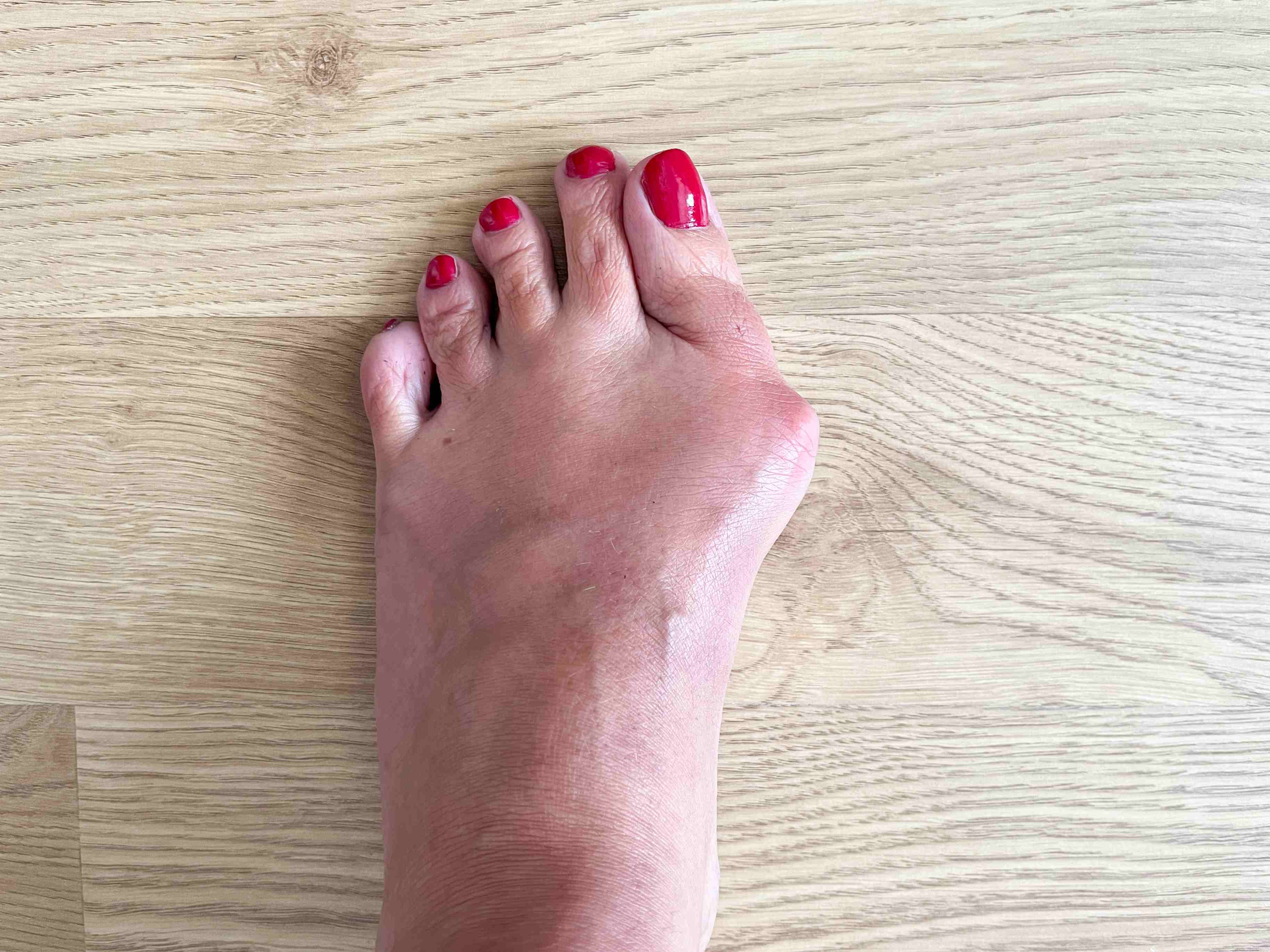 hallux valgus 1